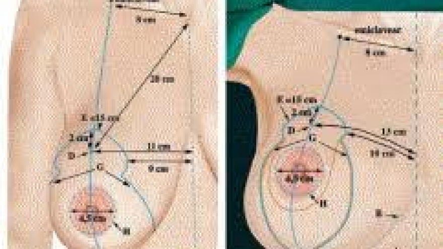 Nâng ngực một thời gian, bị vỡ túi ngực mà không hề hay biết